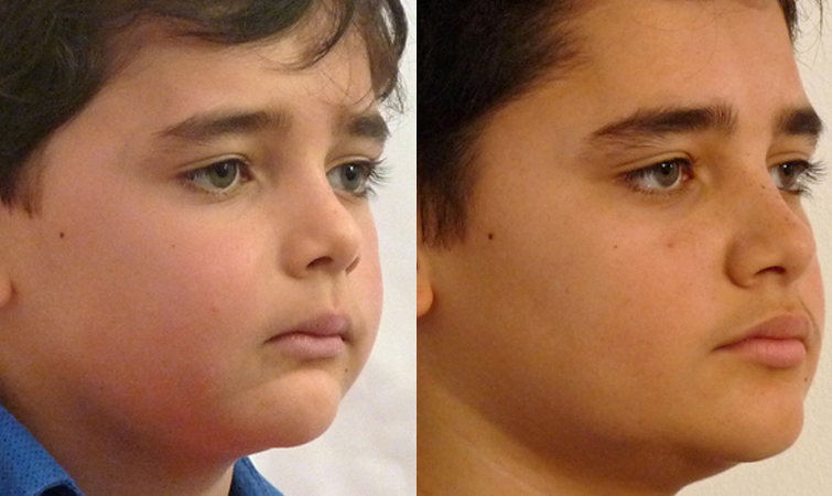Facial Orthotropics Before and After Young Male