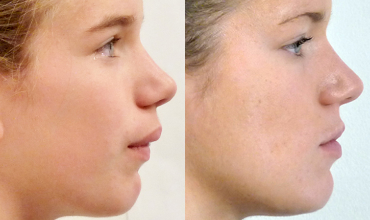 Facial Orthotropics Before and After Female