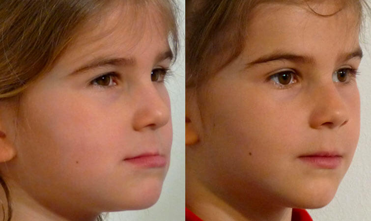 Young Girl Orthodontic Treatment Before and After