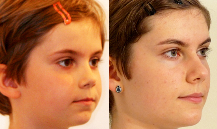 Facial Orthotropics Before and After Female