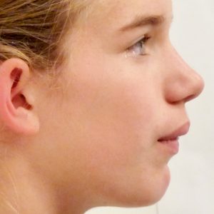 Girl Before Orthodontic Treatment