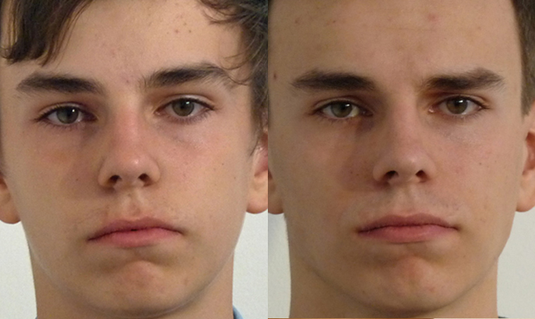 Facial Orthotropics Before and After Male
